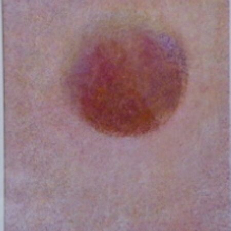 A picture of the skin with a blood spot.